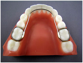 Defay Orthodontics Bite plate