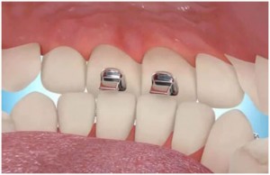 Straightening teeth Defay orthodontics